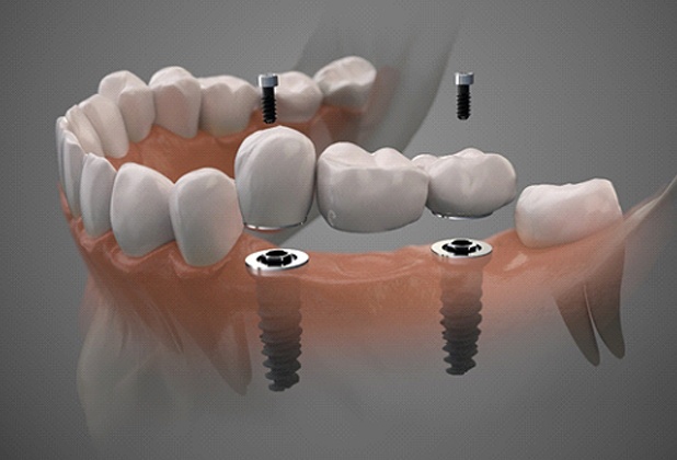 Digital illustration of implant dental bridge in Beverly Hills