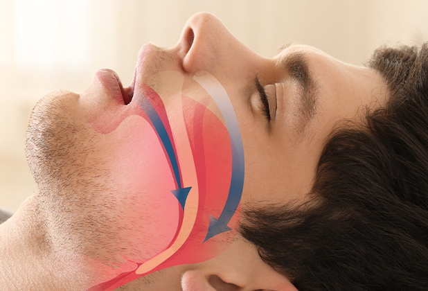 Man with sleep apnea snoring with animated blocked airway over profile