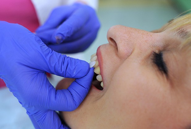 Cosmetic dentist in Beverly Hills comparing veneers to patient’s teeth