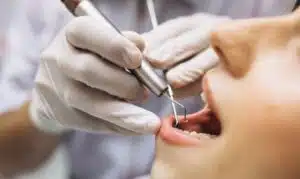 Tooth Extraction Beverly Hills